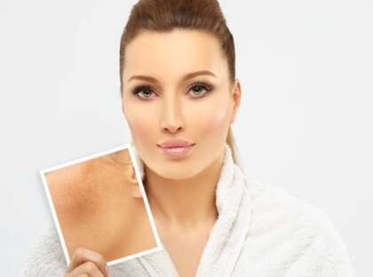 Freckles,dark spots,hyperpigmentation(melasma or chloasma)