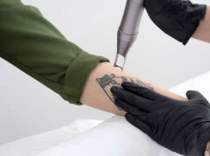 Beautician using laser device to remove an unwanted tattoo from female arm. Concept of erasing tattoos as expensive procedure in a cosmetology clinic
