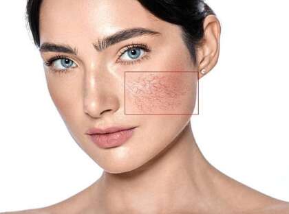Couperose on female face skin. Woman showing problems couperose-prone sensitive skin, isolated
